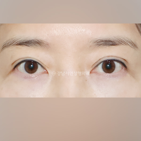 두줄따기 라인낮추기 AFTER