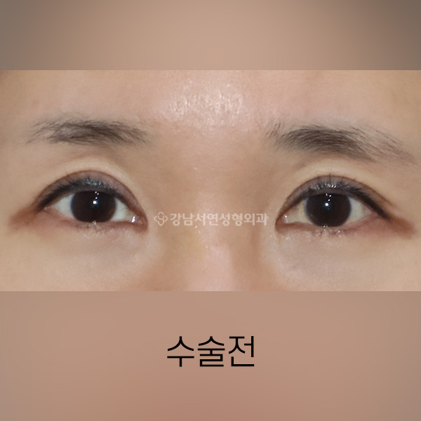 꺼진눈개선 BEFORE