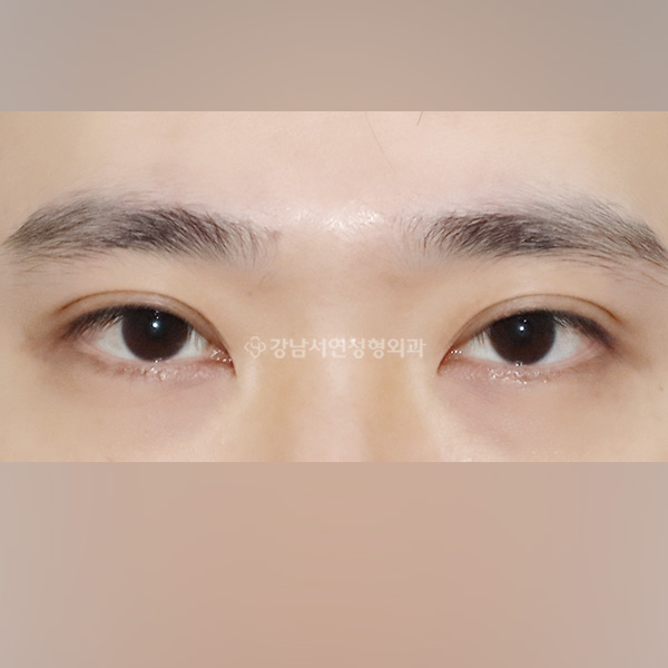 남자 쌍꺼풀감추기 BEFORE