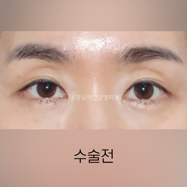 눈 위 지방이식 + 절개쌍꺼풀 재수술 BEFORE