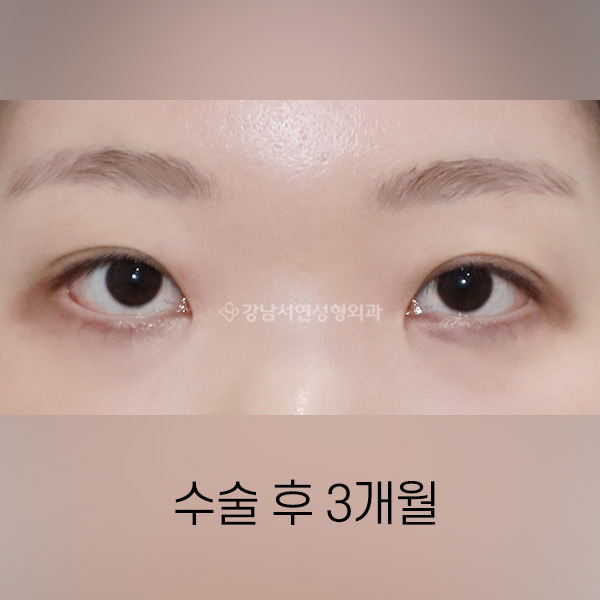 절개눈매교정 라인낮추기 AFTER