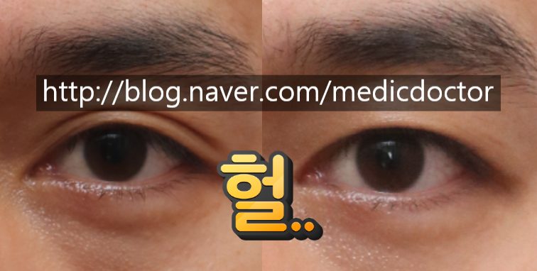 쌍꺼풀 없애는 수술 쌍꺼풀 없애는 법 무쌍 눈매교정 부작용