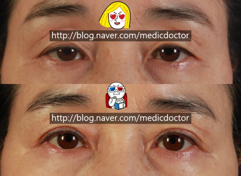 상안검 수술 중년 쌍꺼풀 수술 처진 눈꺼풀