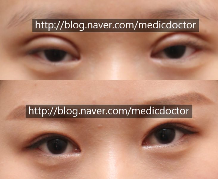 쌍꺼풀 부작용 안전한 절개 쌍꺼풀 수술