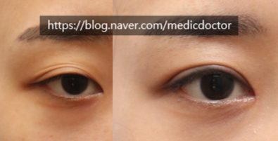눈위 꺼짐 함몰눈 수술 교정 여러겹 쌍꺼풀 교정