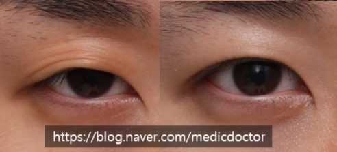 쌍꺼풀 부작용 합병증을 줄이는 방법(쌍수 망함)