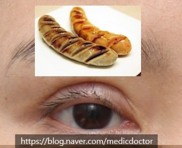 소세지눈 쌍수 소세지눈 재수술