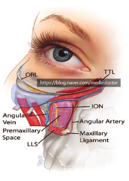 Premaxillary space- 이거를 잘 알아야 눈밑지방 재배치 수술에 도움이 된다.