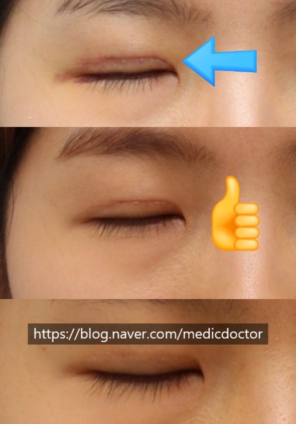 절개눈매교정 수술 쌍꺼풀 흉터 많이 남나요?