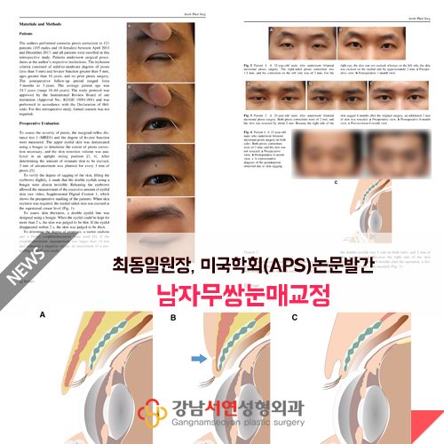 남자무쌍눈매교정과 앞트임복원 치험례