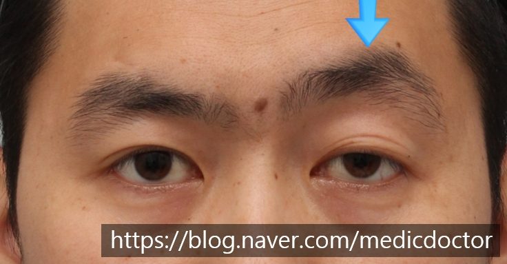 남자 짝눈 교정은 남자무쌍눈매교정으로 수술