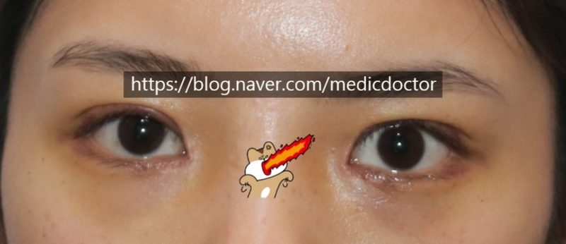 절개눈매교정 풀기 조기 교정하는 경우 - 빠른 재수술 (합병증 예방)