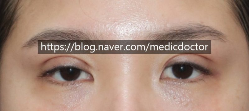 매몰 쌍수 풀기 매몰 법 쌍꺼풀 실 제거 자연유착 풀기