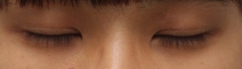 남자 눈매교정 붓기 알아보기 무쌍으로. (쌍꺼풀 안보이게)