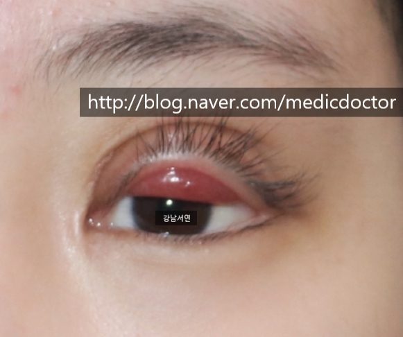 안검하수 재수술, 눈매교정 부작용, 눈매교정 망한 후기