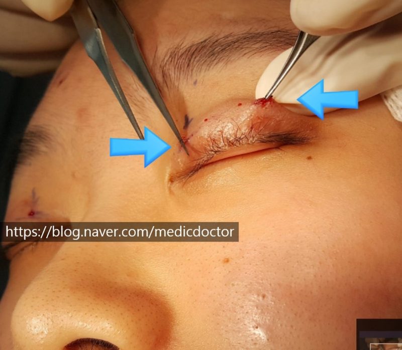 쌍커플 풀기, 메몰풀기, 쌍수풀기, 메몰 실제거, 자연유착법 실제거,쌍커풀 풀기