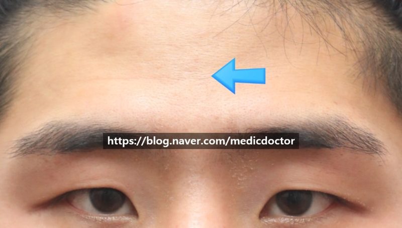 이마로 눈뜨기 - 남자 무쌍 눈매교정 으로 해결