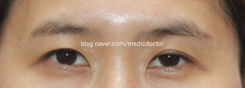 짝눈 교정 , 한쪽 눈 졸려 보이는 경우 절개 눈매교정 으로 수술