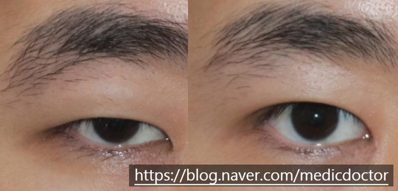 남자 비절개 눈매교정 하면 안되는 이유와 부작용