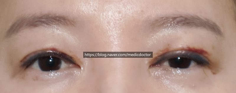 안검하수 조기교정 (눈위 지방이식 조기교정)
