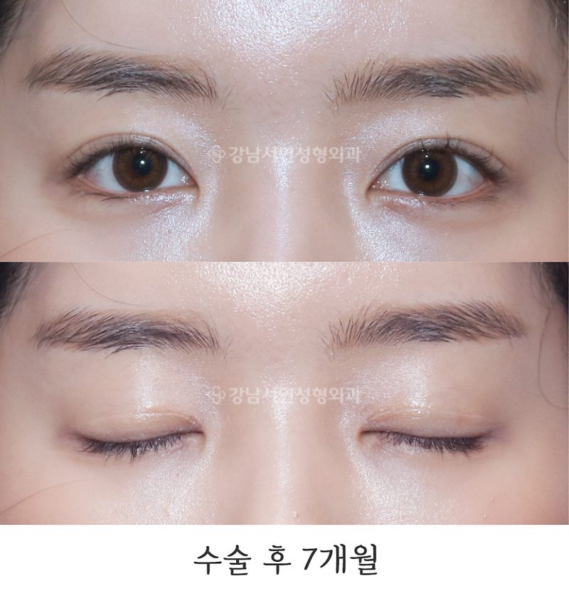 강남서연성형외과 절개눈매교정 전후 사진