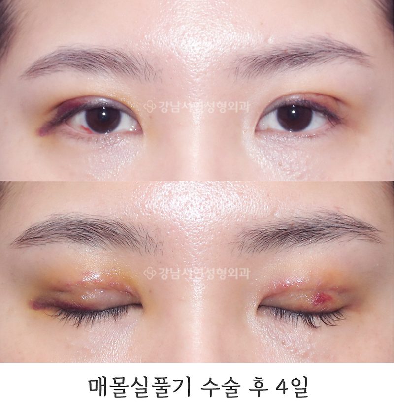강남서연성형외과 매몰실풀기+매몰 재수술 / 라인낮추기 전후 사진