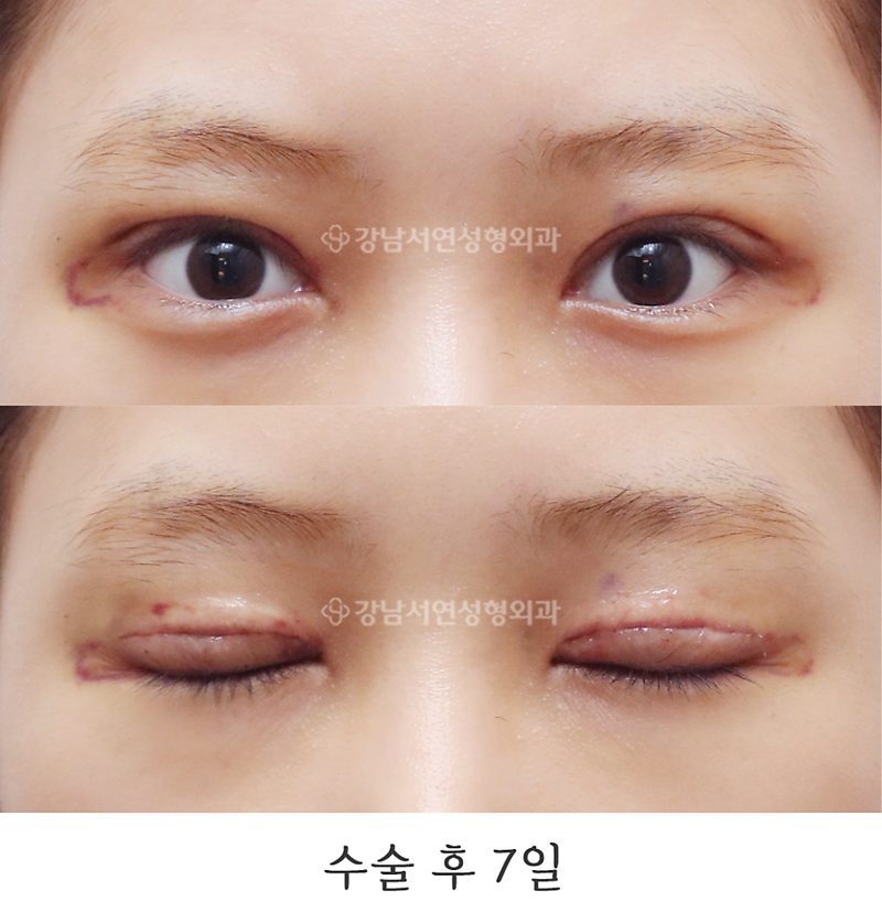 강남서연성형외과 쌍꺼풀 재수술(두줄따기 / 라인낮추기) 전후 사진