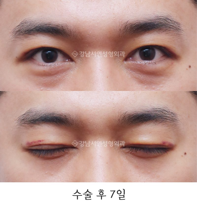강남서연성형외과 남자 절개눈매교정 / 무쌍눈매교정 / 쌍꺼풀 없애기 전후 사진