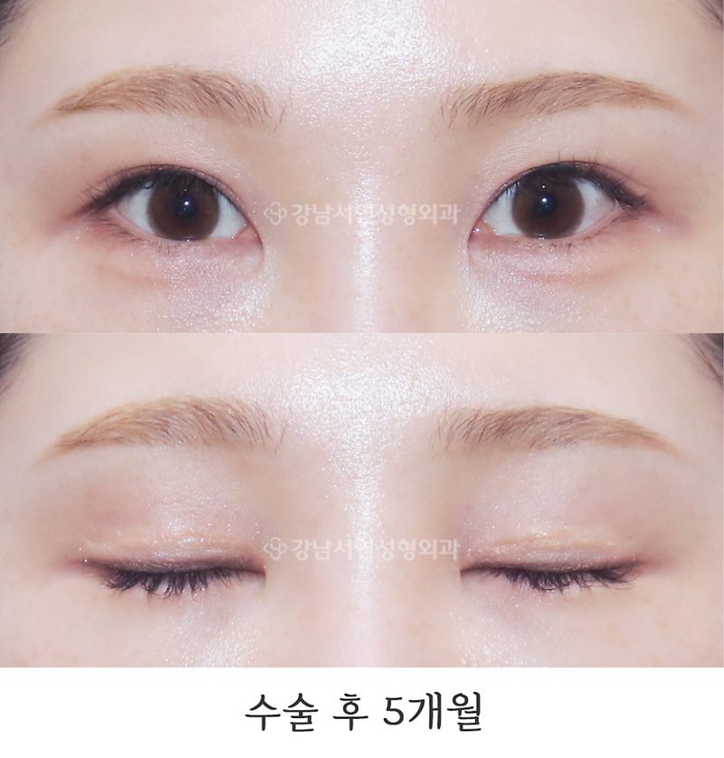 강남서연성형외과 절개눈매교정 재수술, 앞트임, 뒤트임(뒷트임), 밑트임 전후 사진