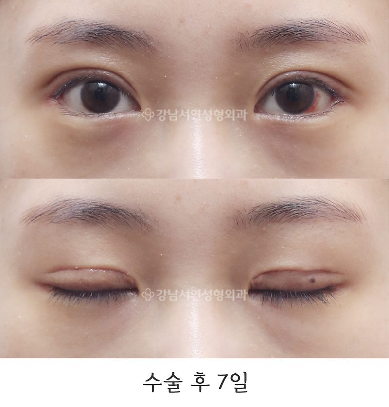 절개눈매교정, 뒤트임(뒷트임), 밑트임 전후 7일, 1개월 10개월 사진
