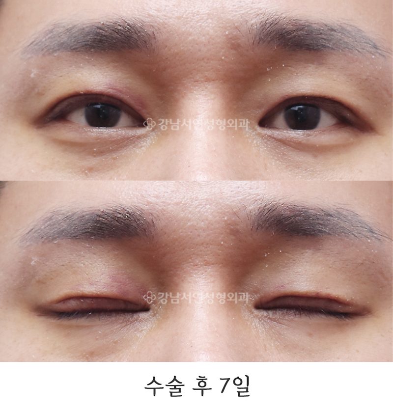강남서연성형외과 남자 절개눈매교정 재수술 / 라인낮추기 일주일, 2달, 3달 사진