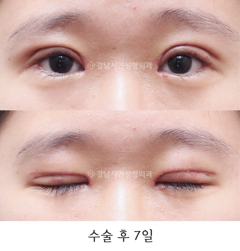 강남서연성형외과 쌍꺼풀 재수술(두줄따기 / 라인낮추기) 전후 사진