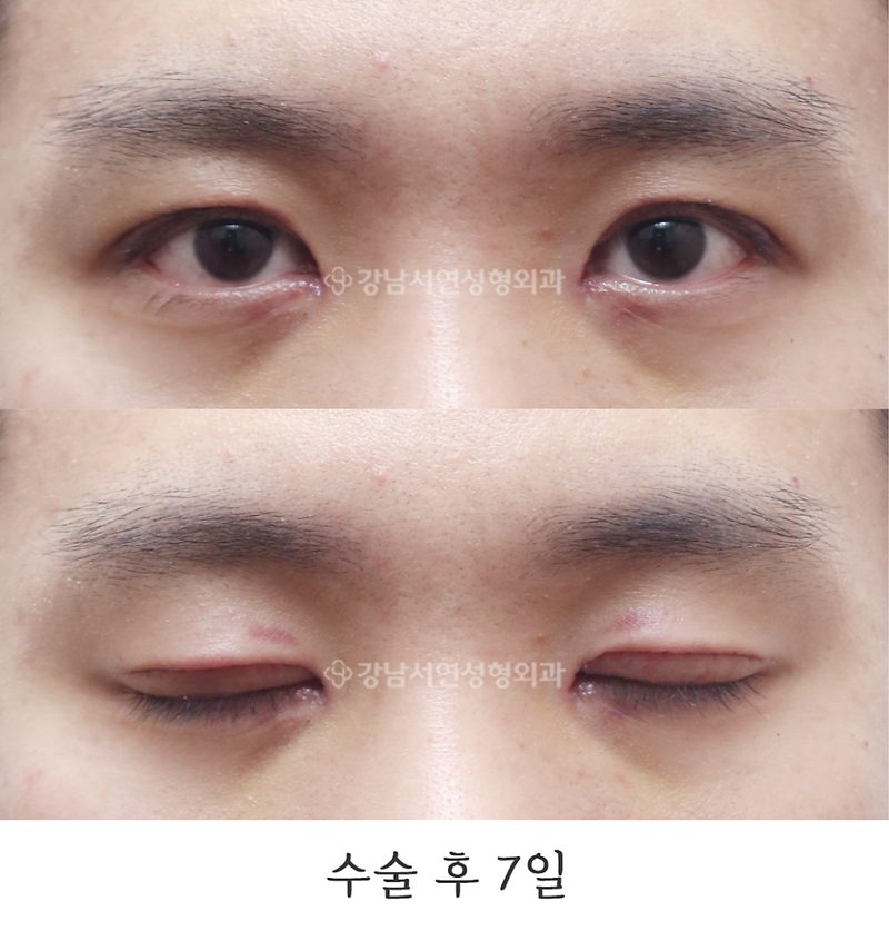 강남서연성형외과 남자 절개눈매교정 / 무쌍눈매교정 / 쌍꺼풀 없애기 + 앞트임 전후 사진