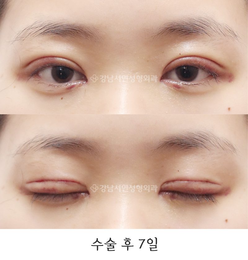 강남서연성형외과 절개눈매교정, 앞트임 전후 7일, 4개월, 9개월 사진