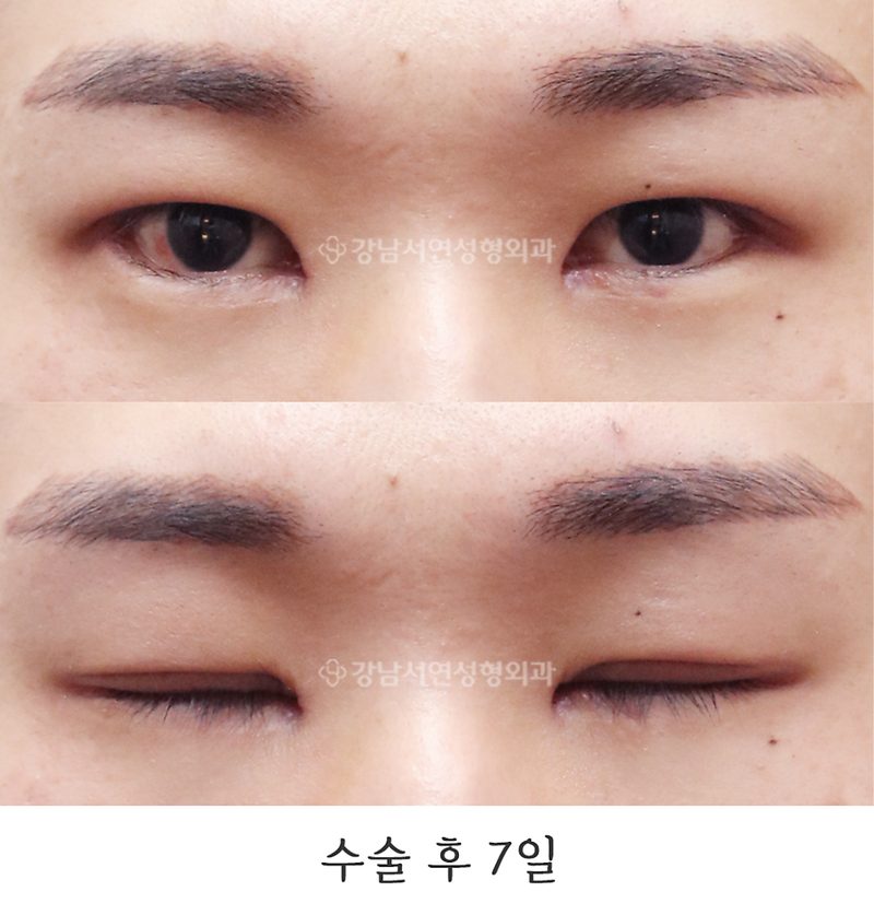 강남서연성형외과 남자 절개눈매교정, 앞트임 뒤트임, 밑트임 전후 일주일, 6개월 사진