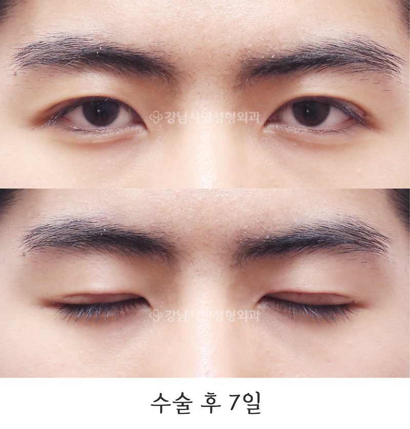 강남서연성형외과 남자 절개눈매교정, 무쌍눈매교정, 라인 낮추기, 쌍꺼풀 없애기, 무쌍수술 6개월 사진