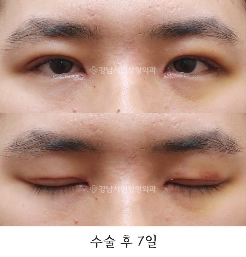 강남서연성형외과 남자 절개눈매교정, 앞트임 전후 일주일, 3개월 사진