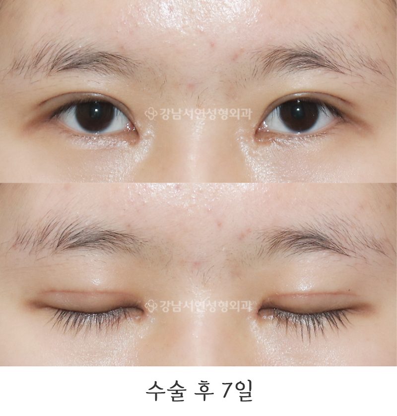 강남서연성형외과 절개눈매교정, 앞트임 뒤트임, 밑트임 전후 일주일, 6개월 사진