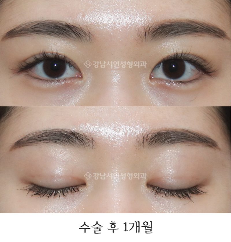 강남서연성형외과 매몰쌍꺼풀 1개월 사진