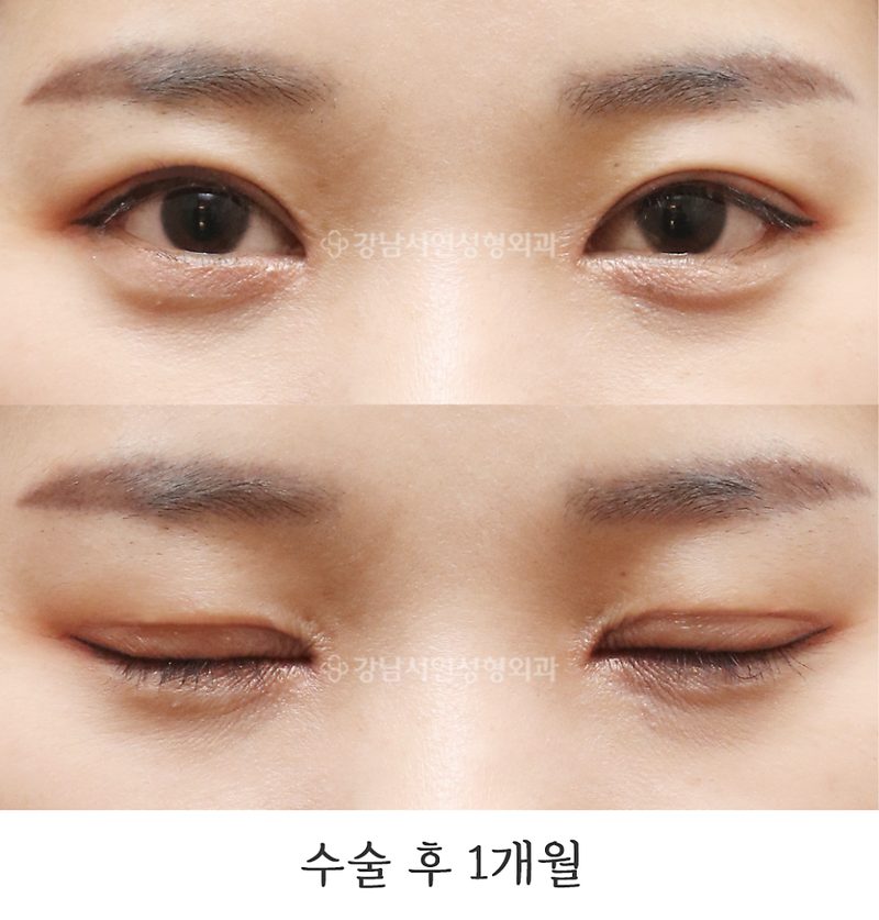 강남서연성형외과 절개눈매교정 재수술(라인 낮추기), 앞트임, 뒤트임, 밑트임 전후 1개월, 6개월 사진