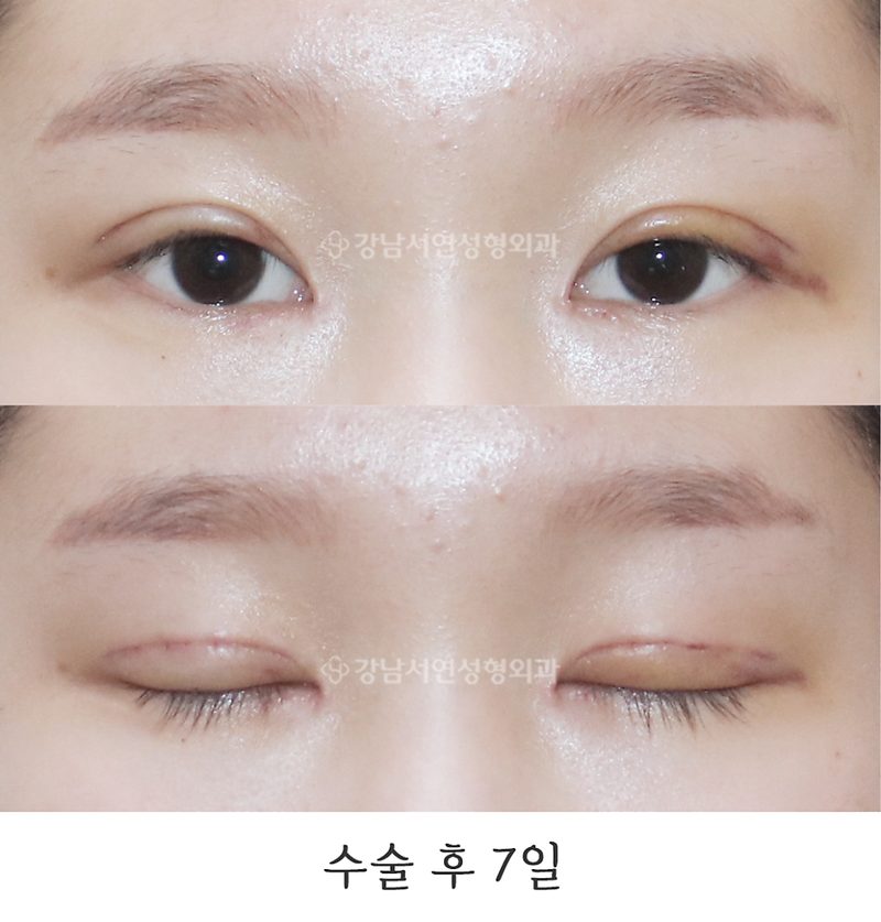 강남서연성형외과 절개눈매교정, 앞트임 전후 일주일, 1개월 사진