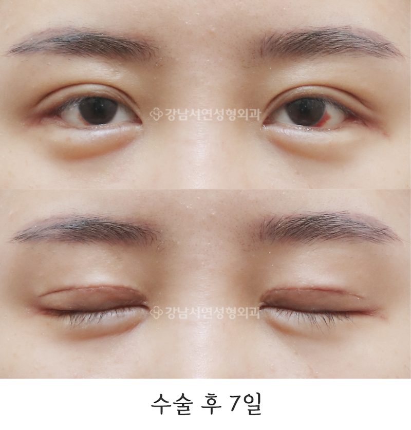 강남서연성형외과 절개눈매교정 재수술, 뒤트임, 밑트임 전후 일주일, 6개월 사진