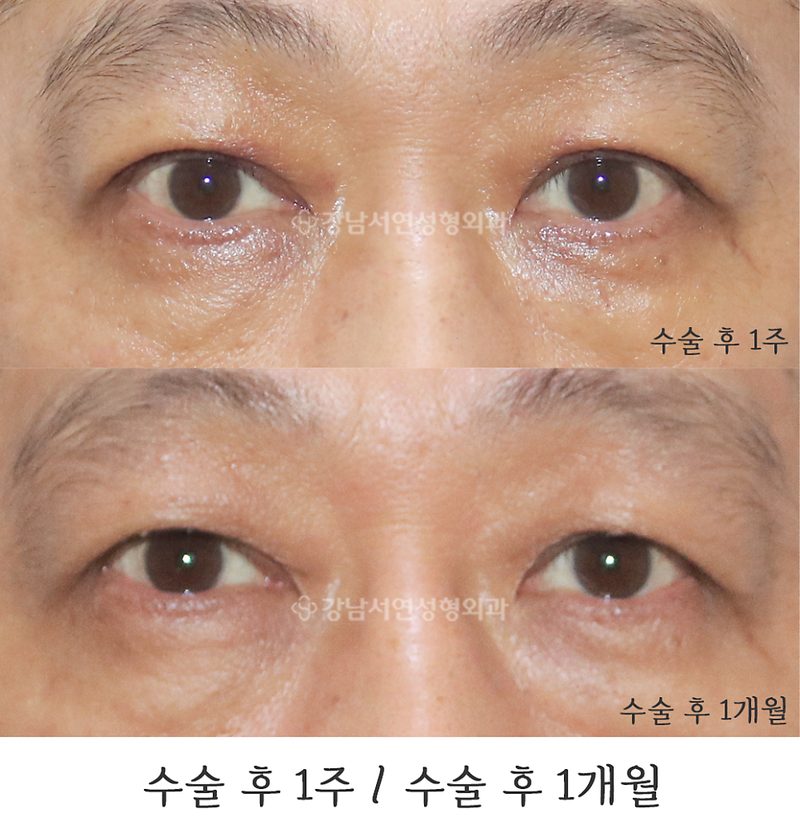 쌍꺼풀 없애기, 무쌍눈매교정 사진