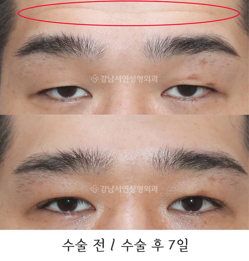 남자 무쌍눈매교정 사진(feat.강남서연성형외과)