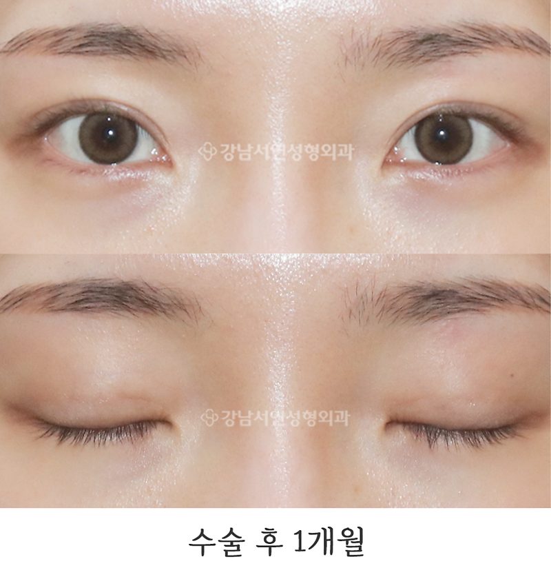 자연유착(매몰 쌍꺼풀) 한 달 전후 사진(feat.강남서연성형외과)