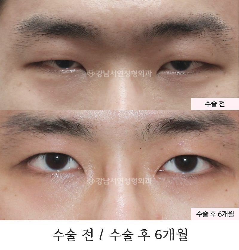 남자 무쌍눈매교정, 앞트임 6개월 전후 사진(feat.강남서연성형외과)