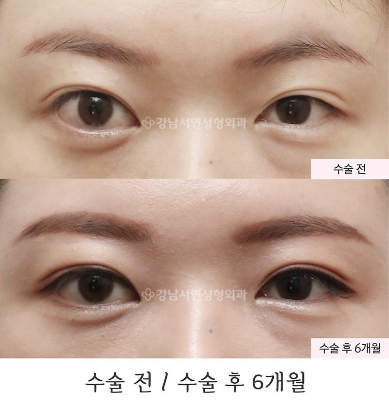 절개눈매교정 재수술 6개월 전후 사진(feat.강남서연성형외과)