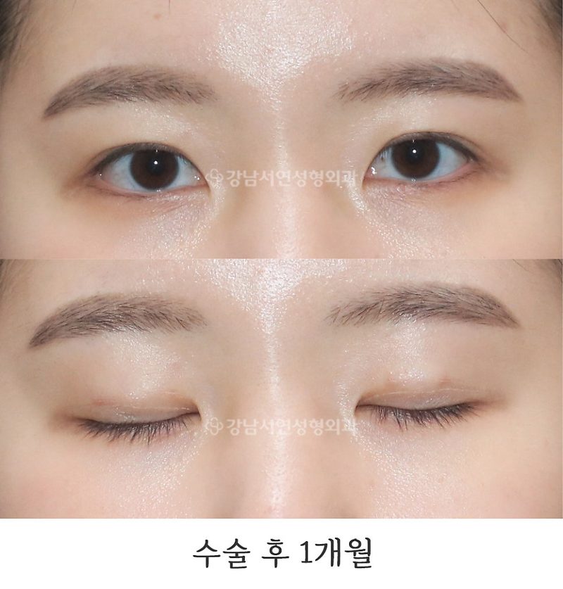 매몰실풀기 1개월 전후 사진(feat.강남서연성형외과)
