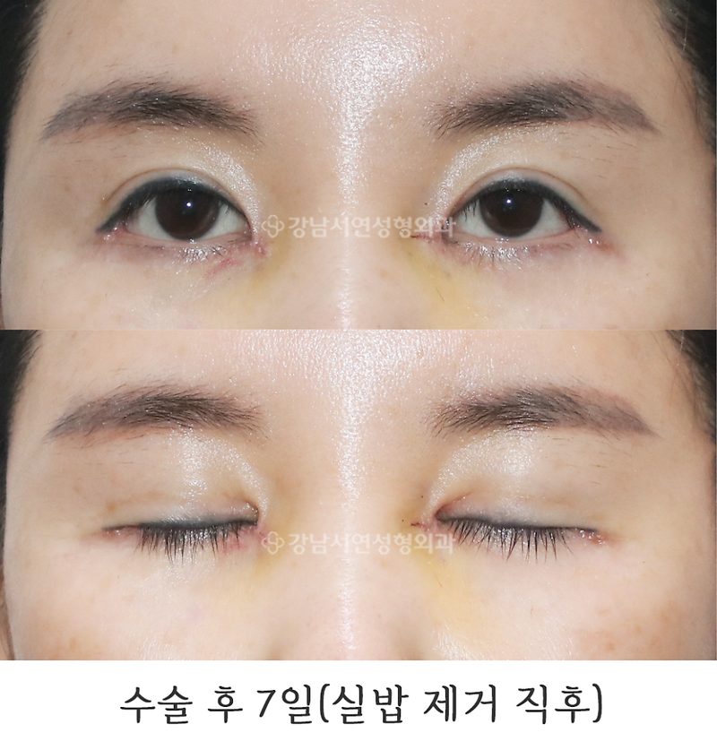 앞트임 복원 1년 전후 사진(feat.강남서연성형외과)