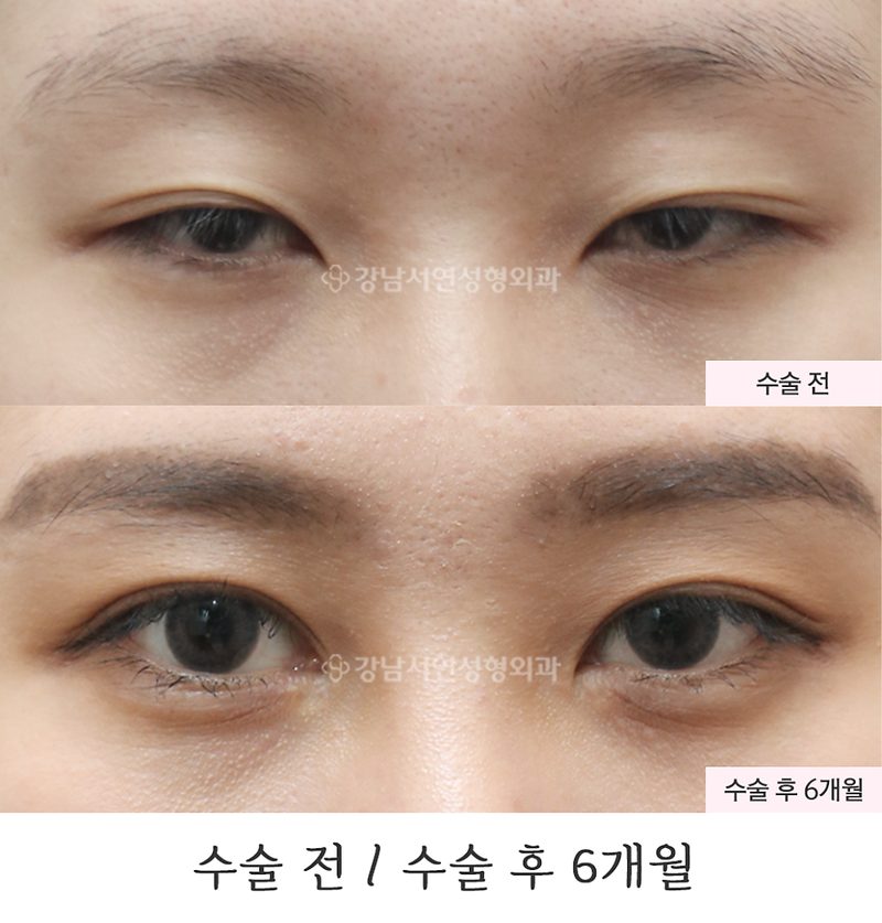 절개눈매교정, 앞트임, 뒤트임 6개월 전후 사진(feat.강남서연성형외과)
